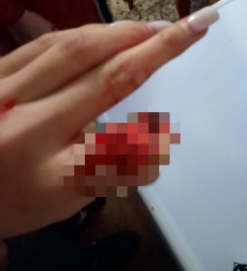 Агрессор оторвал палец девушке
